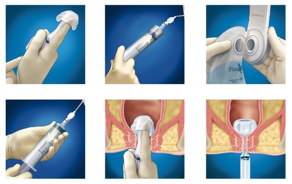 Flexi-Seal® Signal FMS je pomôcka pre ošetrovanie pacientov s fekálnou inkontinenciou.